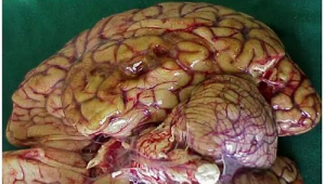 小孩枕大池蛛網膜囊腫_小孩枕部蛛網膜囊腫